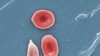 A colorized microcsope image made available by the Sickle Cell Foundation of Georgia via CDC.