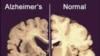 Vitamin D May Help Avert Alzheimer’s Disease, Dementia