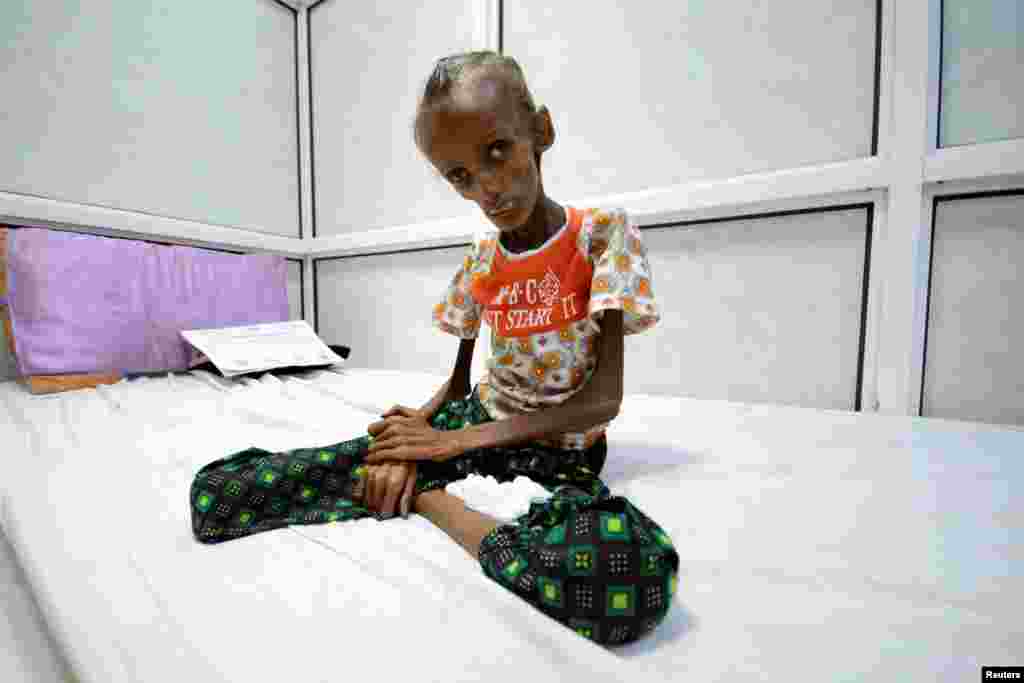 Saida Ahmad Baghili, 18 tahun, yang menderita kurang gizi (malnutrisi) akut, dirawat di rumah sakit al-Thawra di kota Houdieda, Yaman.