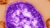 An undated electron microscope image of a measles virus particle.