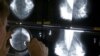 cancer breast