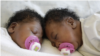Les jumelles Siphosethu et Amahle Tyhalisi ont été séparés avec succès. Photo Département de la santé du Cap-Occidental