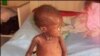 South African child shows effects of HIV infection